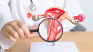 Cervical Cancer