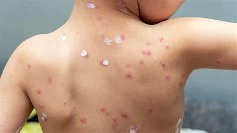 Mumps Outbreak In Delhi