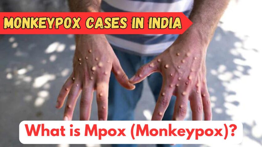 Monkeypox In India